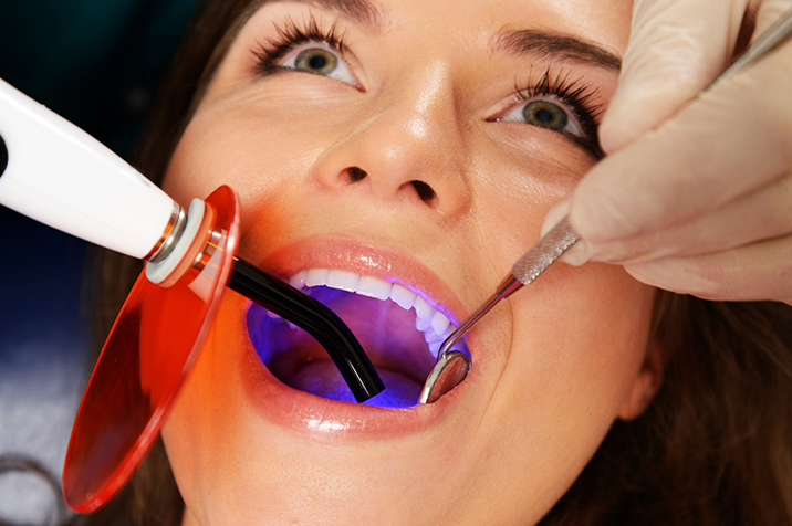 The Importance of Treating Dental Cavities on Time