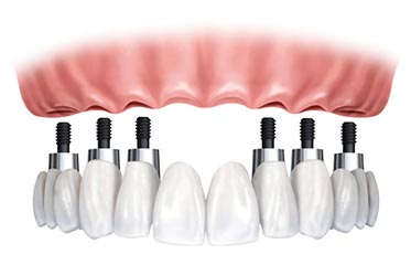 Implant Supported Replacement of Missing or Broken Down Teeth