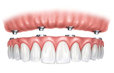 What to Do after Dental Implant Surgery