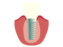 Dental Implants Simi Valley