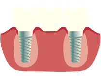 Dental Implants Simi Valley