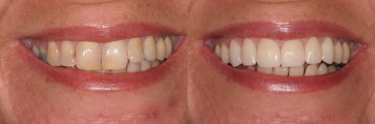 General Dentistry Simi valley dentist Before and after