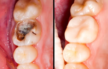 teeth during early pregnancy