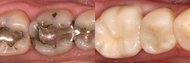 Natural looking tooth colored filling