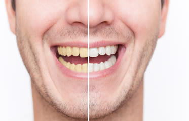 Teeth Whitening – Is It Right for Me?