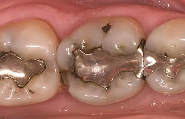 Is There a Difference Between Metal or Silver Fillings & Tooth-colored Fillings?