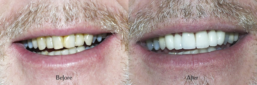 Porcelain Crowns before after Simi Valley