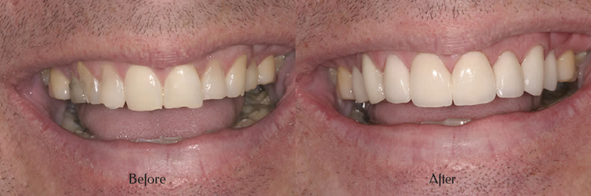 teeth before and after Simi Valley