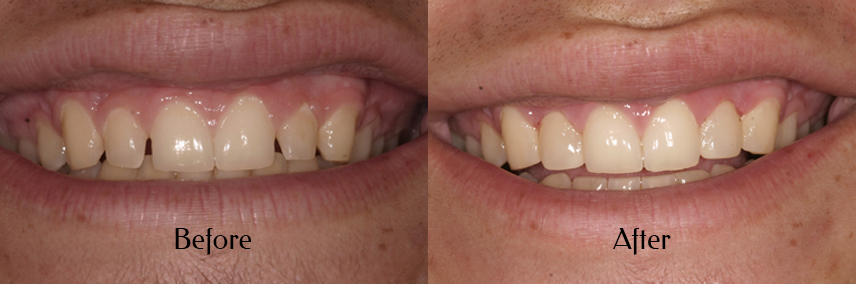 Filling the spaces with veneers. Just 2 veneers make a big difference