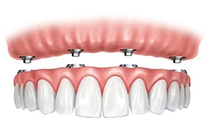 Dental Implants