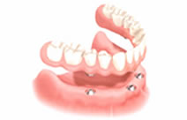 dental implants