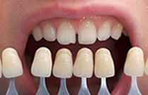 porcelain veneers