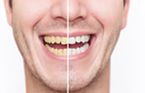 teeth whitening