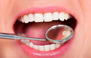 What to Expect with Dental Bonding