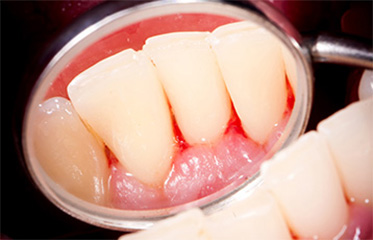 Gingivitis: Symptoms, Treatment and Prevention