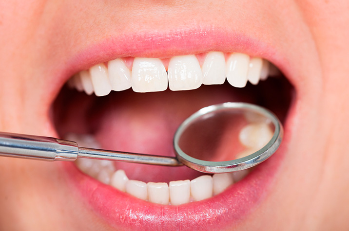 What to Expect with Dental Bonding