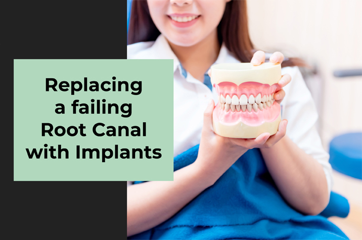 Replacing a Failing Root Canal with Dental Implants