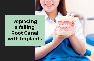 Replacing a Failing Root Canal with Dental Implants