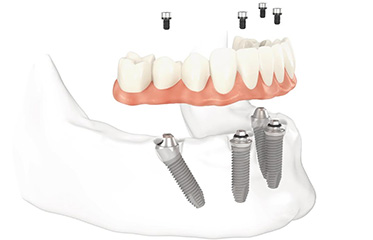 Dental Implants Simi Valley