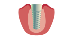 Dental Implants Simi Valley