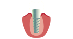 Dental Implants Simi Valley