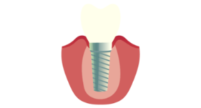 Dental Implants Simi Valley