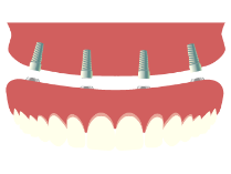 Dental Implants Simi Valley