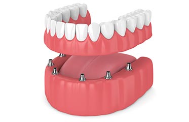 Fixed Denture Simi Valley