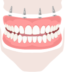 Benefits of the All-on-four dental procedure
