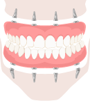 Benefits of the All-on-four dental procedure