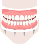 Benefits of the All-on-four dental procedure