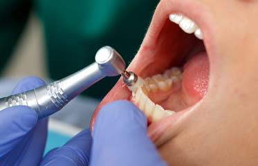 Prophylaxis, dental cleaning Simi Valley
