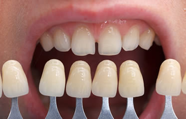 How Do Porcelain Veneers Work?