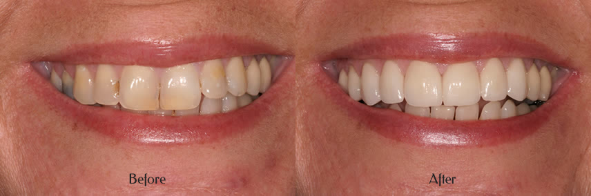 Veneers before and after Simi Valley