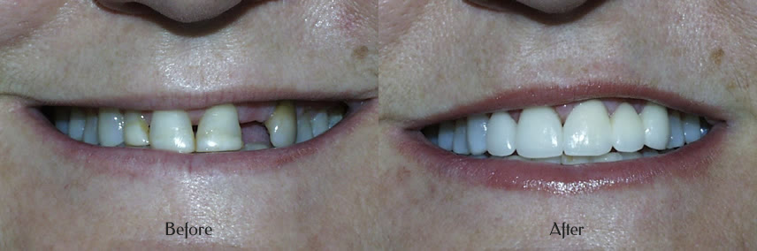 Replacing missing teeth before and after Simi Valley