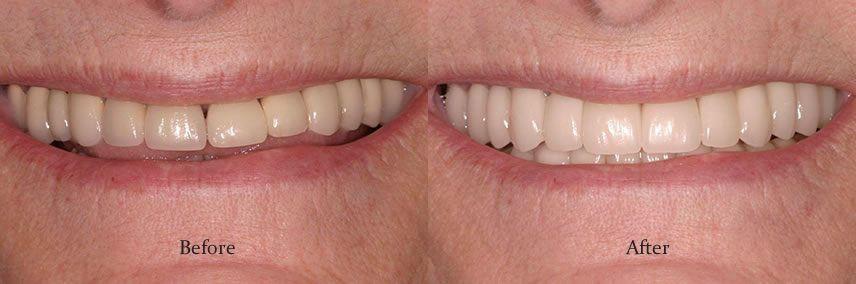 Porcelain Crowns Simi Valley