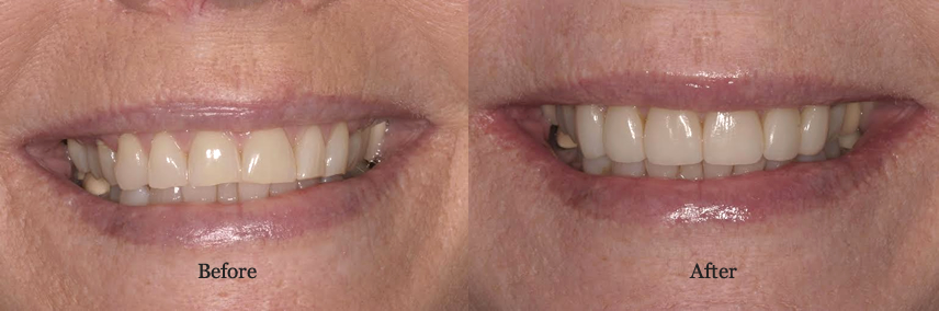 Porcelain Veneers Simi Valley