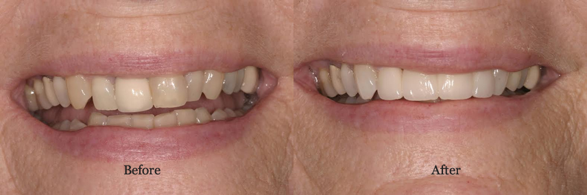 Porcelain Veneers Simi Valley