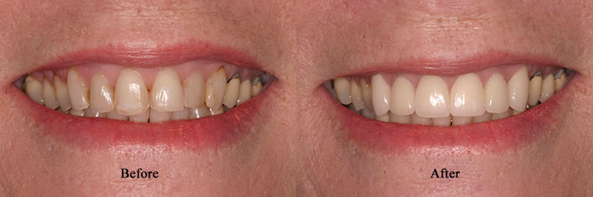 Porcelain Crowns Simi Valley