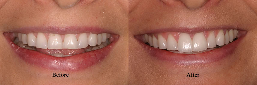 Porcelain Veneers Simi Valley