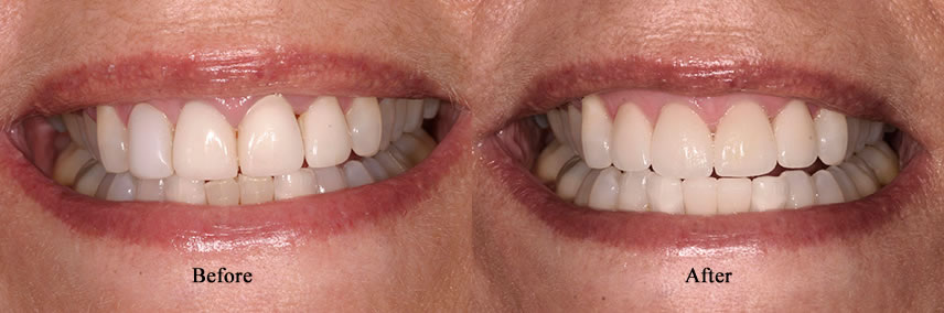 Porcelain Crowns Simi Valley