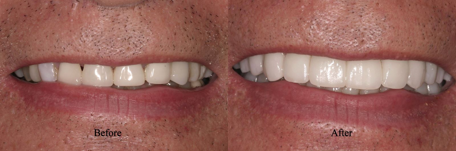 Porcelain Crowns Simi Valley