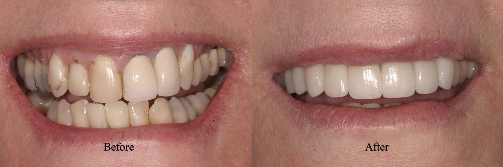 Porcelain Crowns Simi Valley