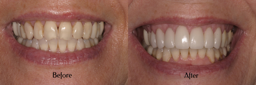 Porcelain Crowns Simi Valley